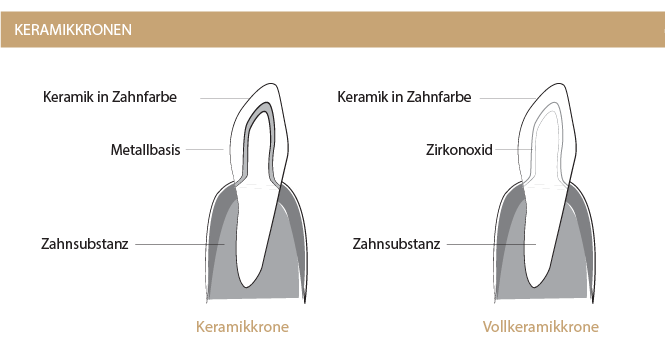 keramikkronen_zahnarzt_boeblingen.png